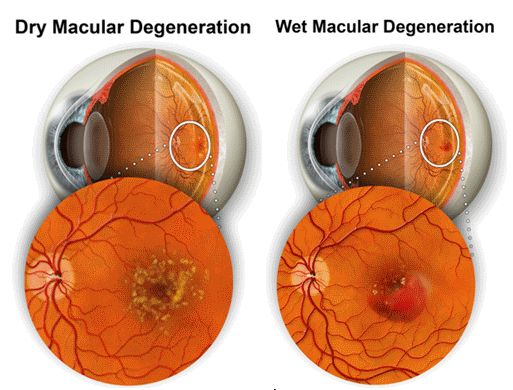 What is Age-Related Macular Degeneration or AMD?