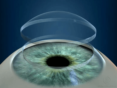 Penetrating Keratoplasty PKP Keratoconus | Fraser Eye Care Center