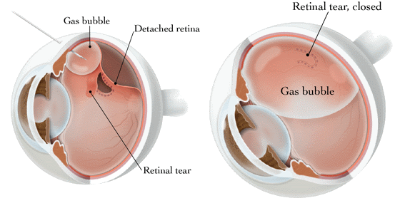 after retinal tear surgery after retinal tear surgery