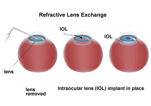 Refractive Lens Exchange Rle Detroit Mi | Rle Michigan