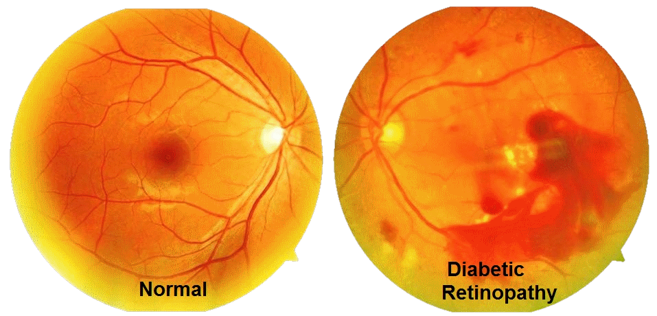 Diabetic Eye Disease Fraser Eye Care Center