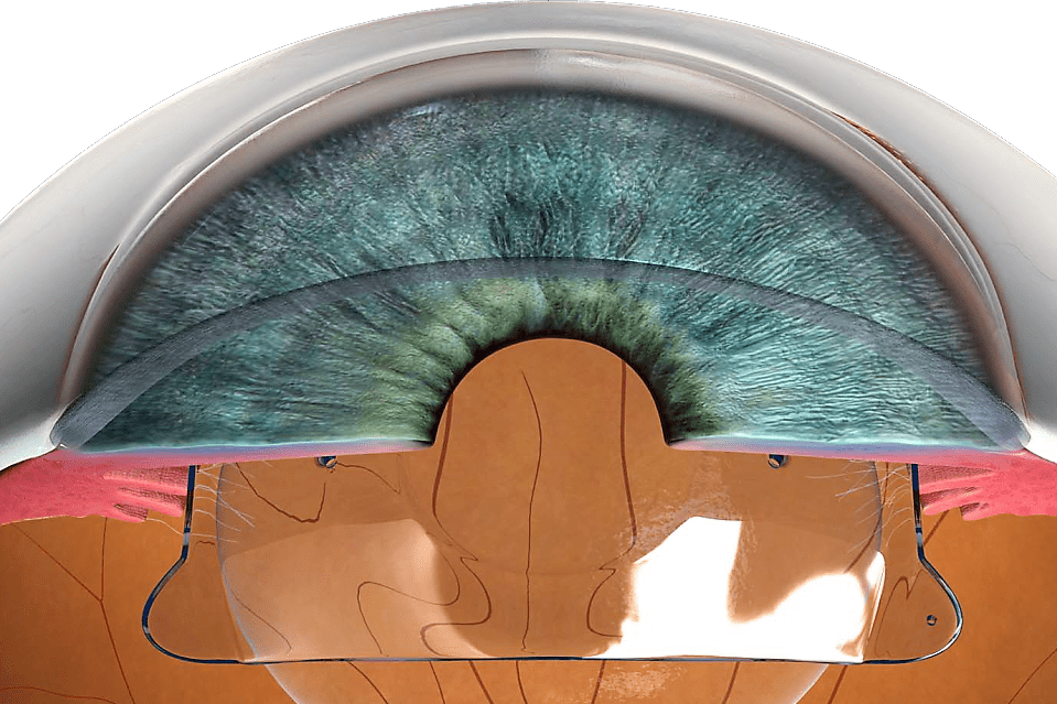 Implantable Contact Lens (ICL) Vision Correction Detroit MI