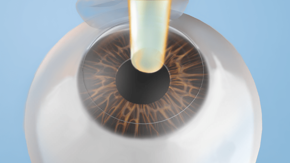 iLASIK Fraser Eye Care Center