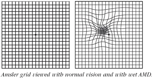 macular degeneration at 37