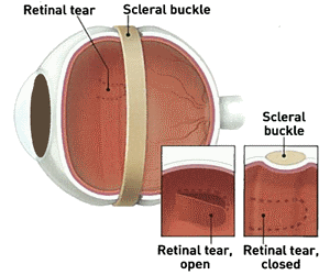 Scleral Buckle Retinal Detachment
