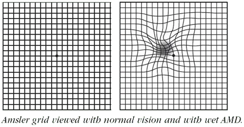 Amsler grid ARMD