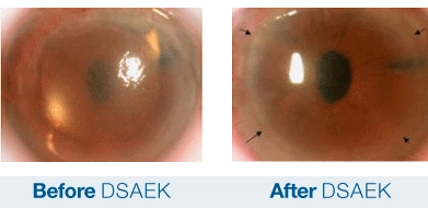 DSAEK corneal transplant before and after
