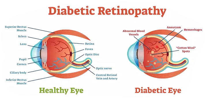 diabetic retinopathy diagram