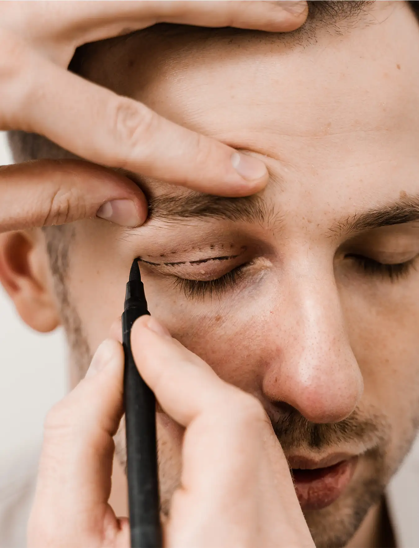 eyelid surgery markings