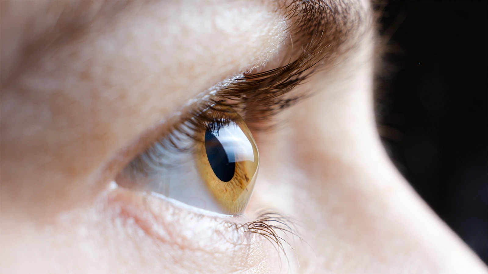 Keratoconus eye close up