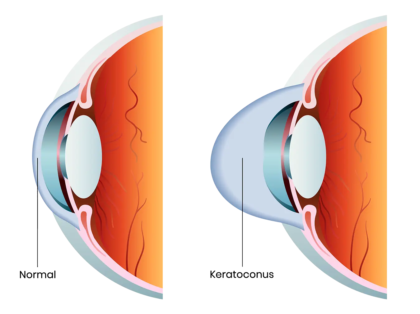 keratoconus diagram