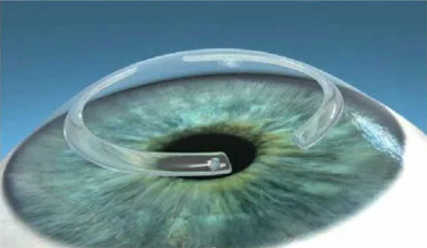 keratoconus treatment