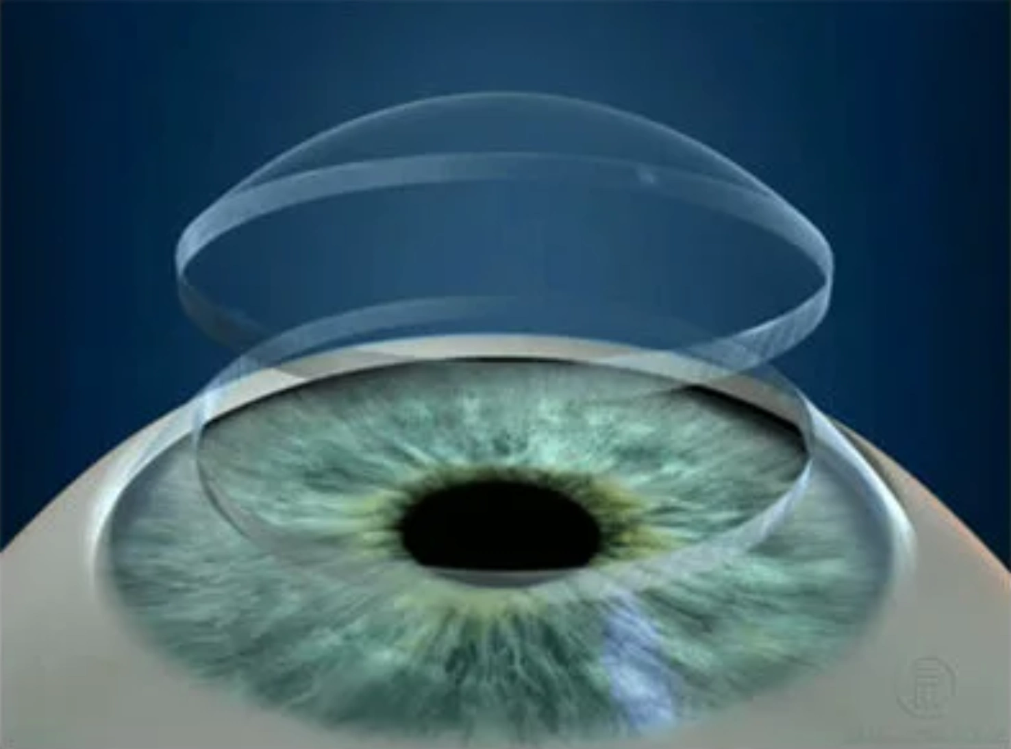 keratoconus treatment