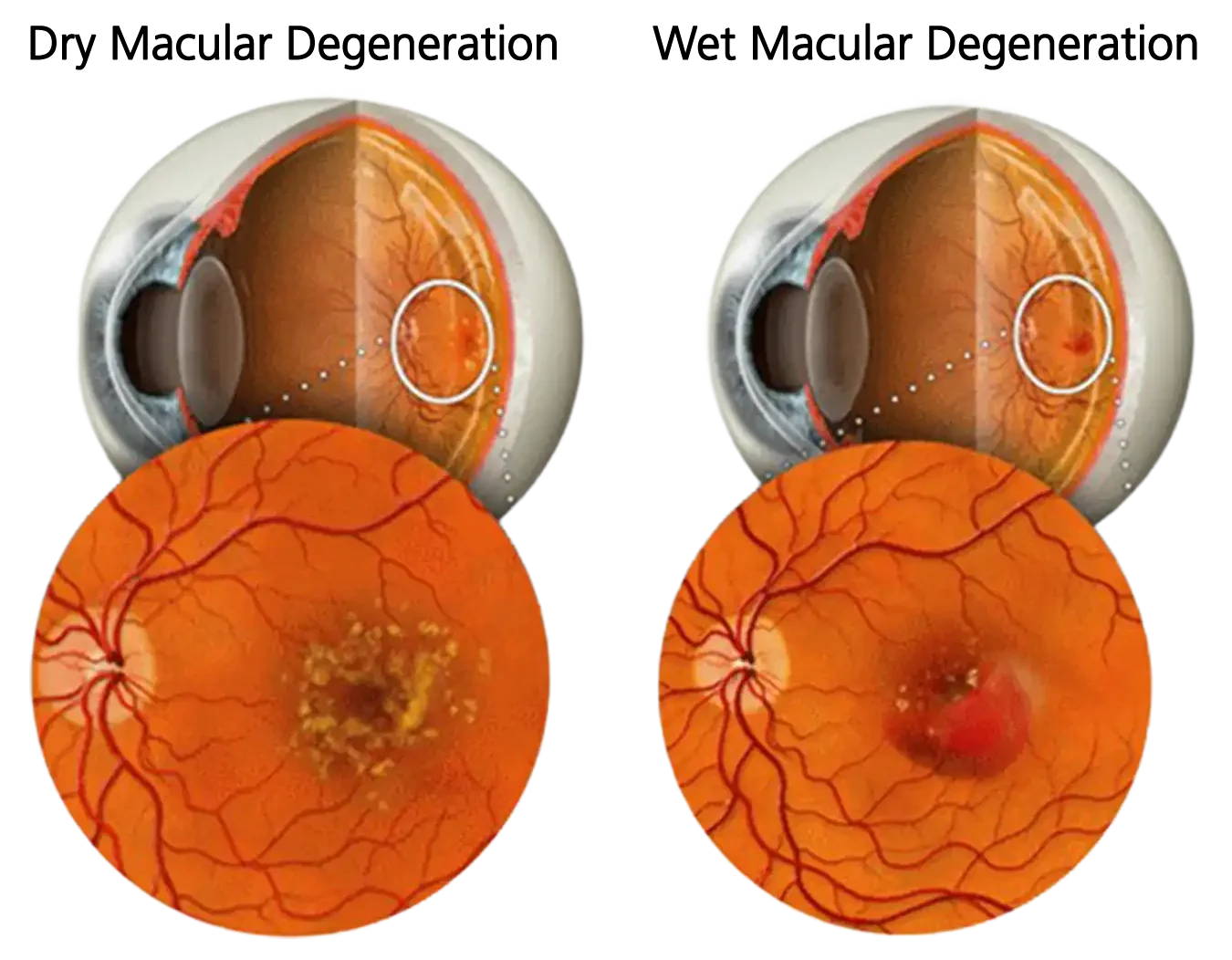 Macular degeneration diagram