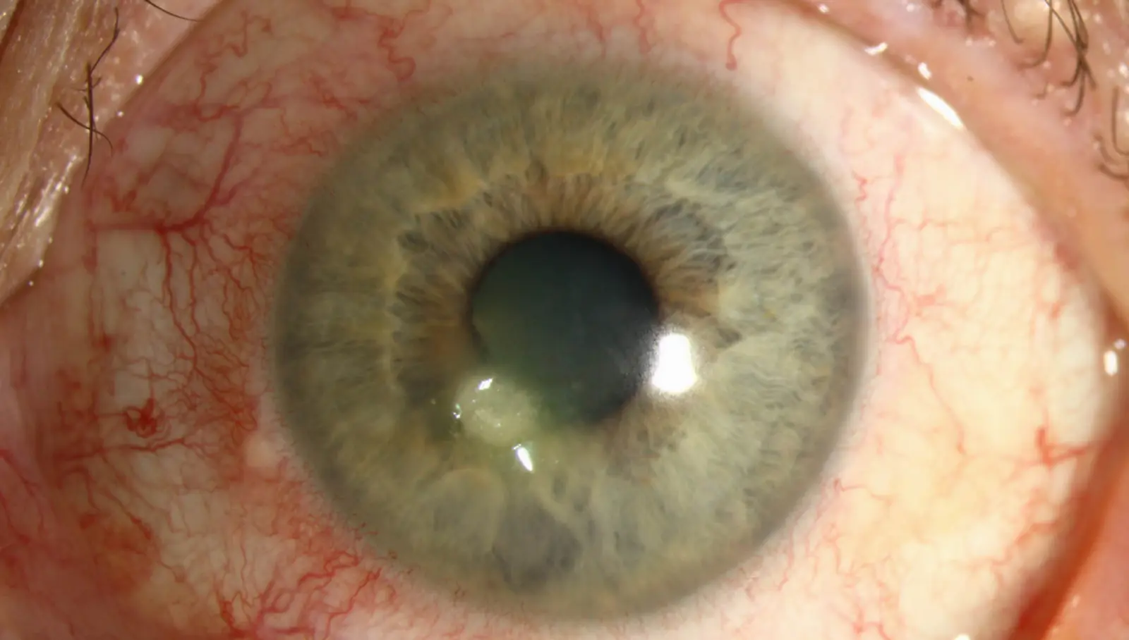 close up of an eye with keratitis